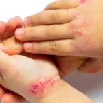 Dermatitis atópica: lanzan una campaña nacional y gratuita para la detección de la enfermedad