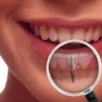 Las tres cosas que tenés que tener en cuenta antes de hacerte un implante odontológico